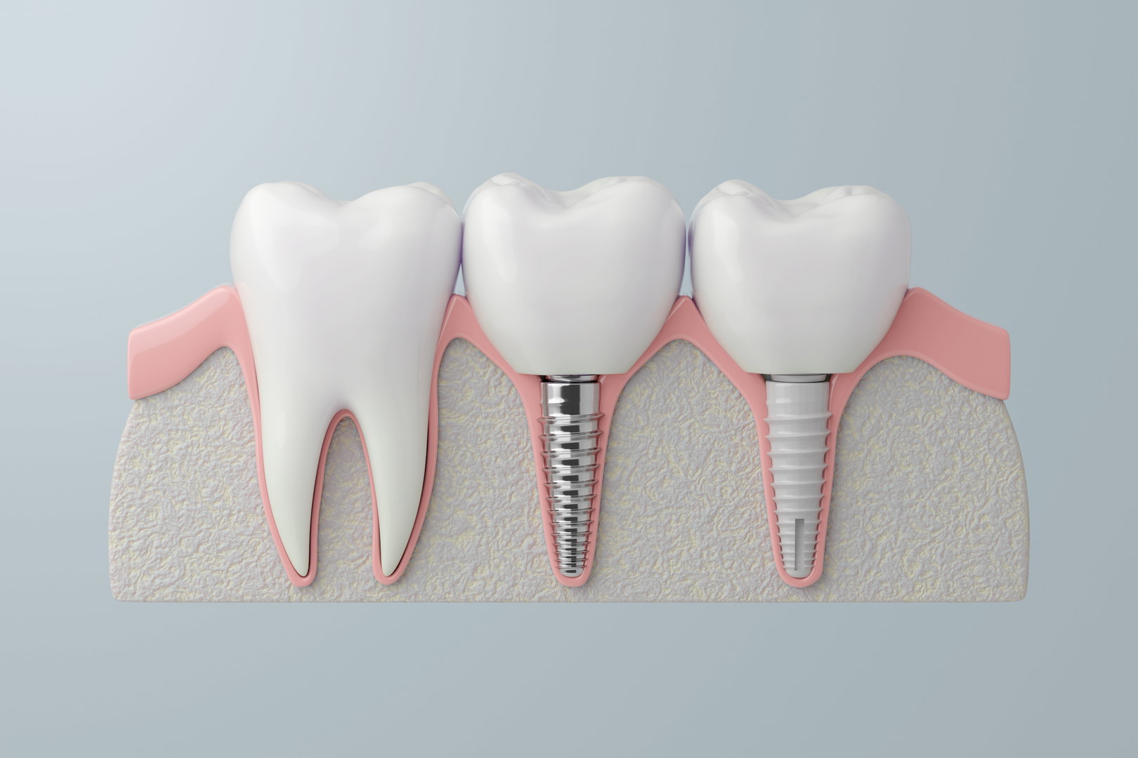 best-implant-treatment2
