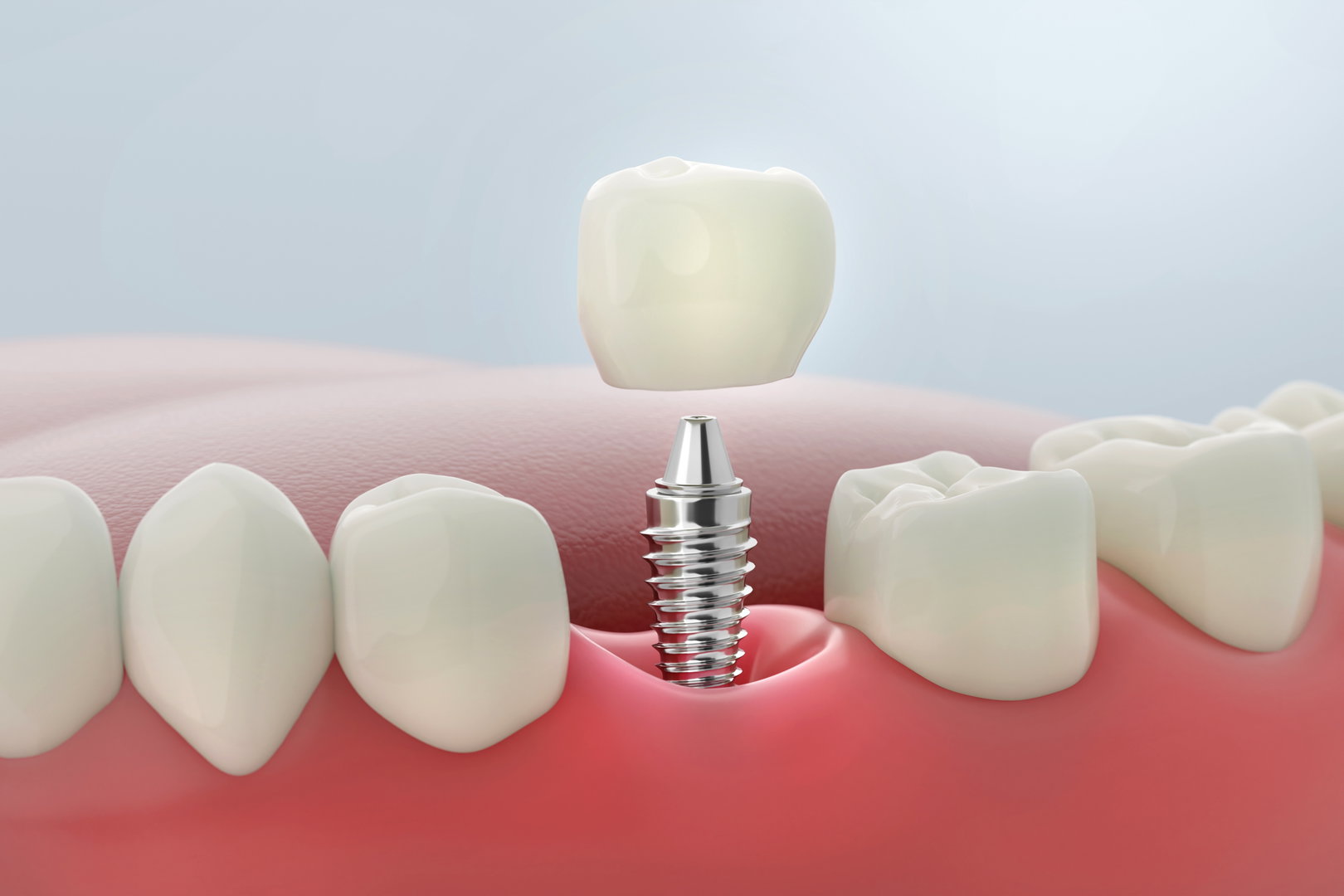 Dental Implants For Missing Teeth