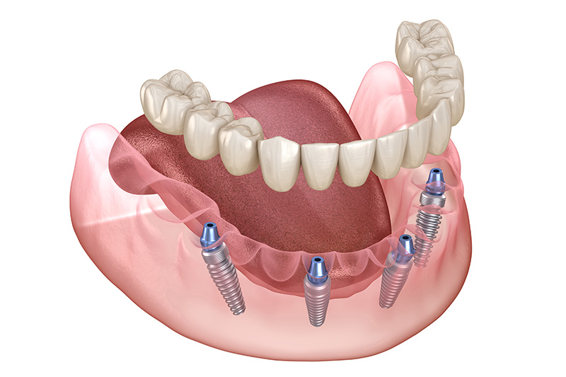 Implants Dentist in Aberdeen